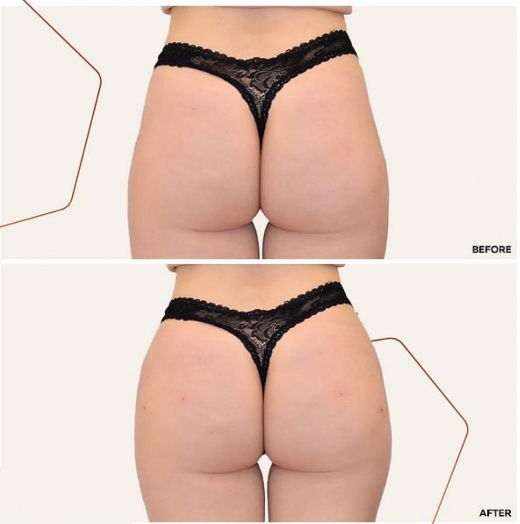 Brazillian Secret Butt Lifter Panties-Instant Lift Your B…