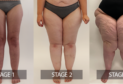 Lipedema - A Medical or Aesthetical Condition And How To Treat It