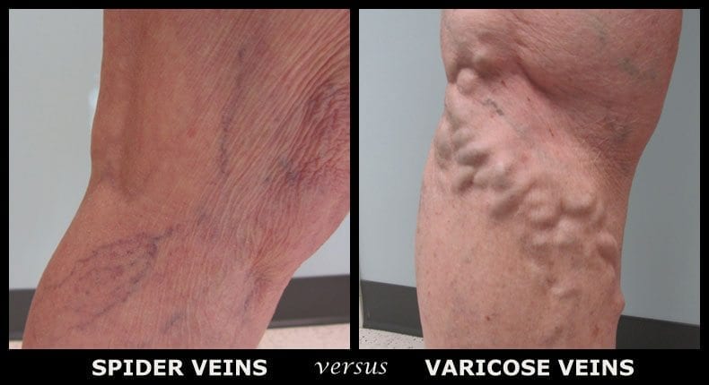 Varicose veins and Spider veins - what is it and how to treat it?