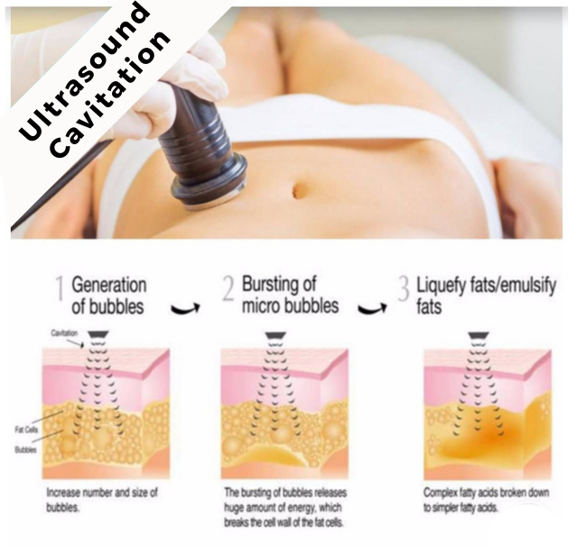 Ultrasound Cavitation - Slimming Therapy Without Surgery - Amwaj Polyclinic  I Dubai Marina JBR Jumeirah Beach Road