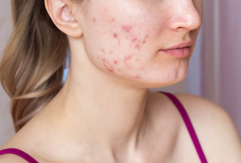 acne scars in dubai