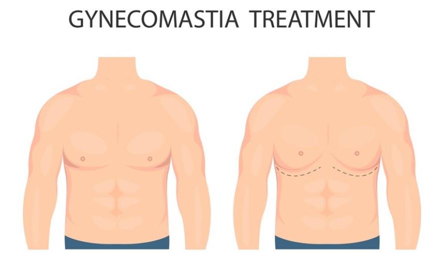 gynecomastia treatment