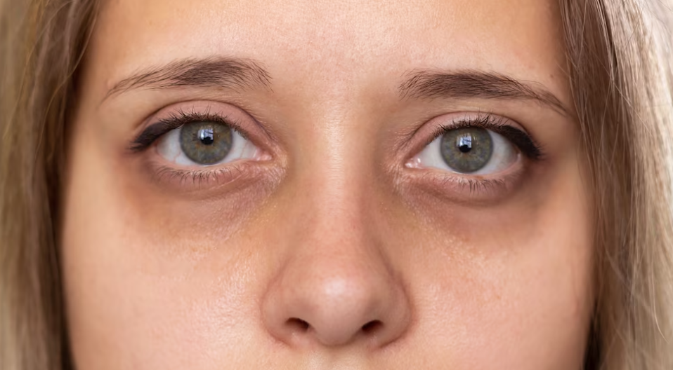 Are Droopy or Saggy Eyes Making You Look Tired?- Discover Endy Eyes Treatment at Amwaj Polyclinic - a Non-Surgical Eye Lift